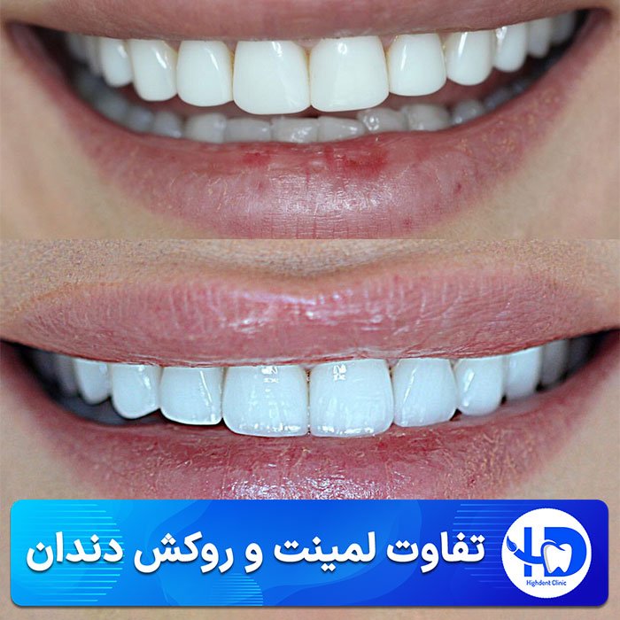 تفاوت لمینت و روکش دندان