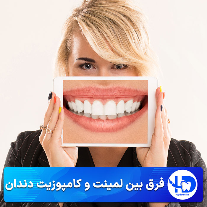 فرق بین لمینت و کامپوزیت دندان