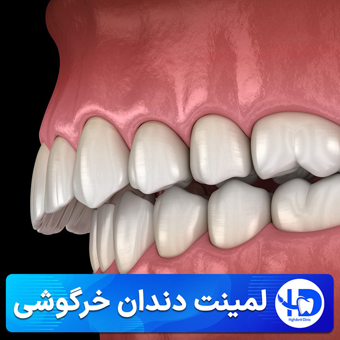 لمینت دندان خرگوشی