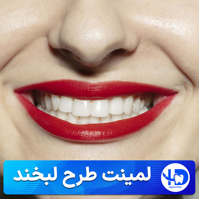 لمینت طرح لبخند