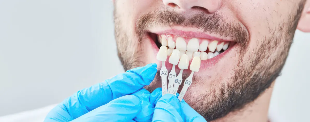 تفاوت لمینت و ارتودنسی