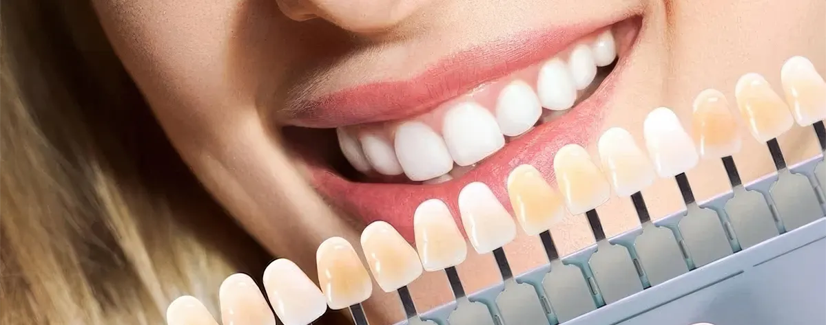 شناخت بهترین لمینت دندان