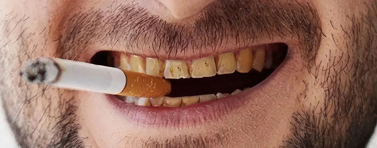 لمینت برای افراد سیگاری