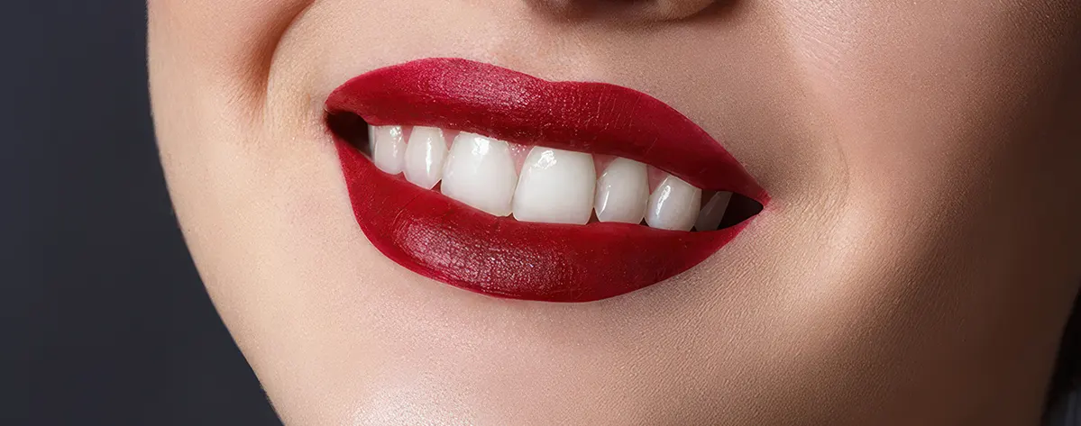 لمینت دندان چیست و چه نقشی در اصلاح دندان و زیبایی آن دارد؟