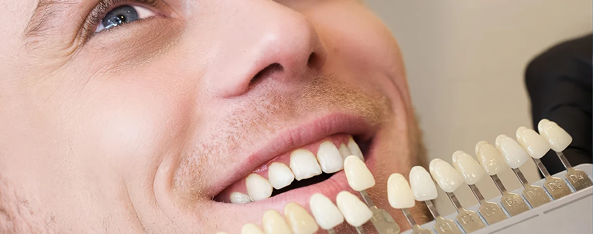 مراحل قبل از انجام لمینت، بررسی جامع