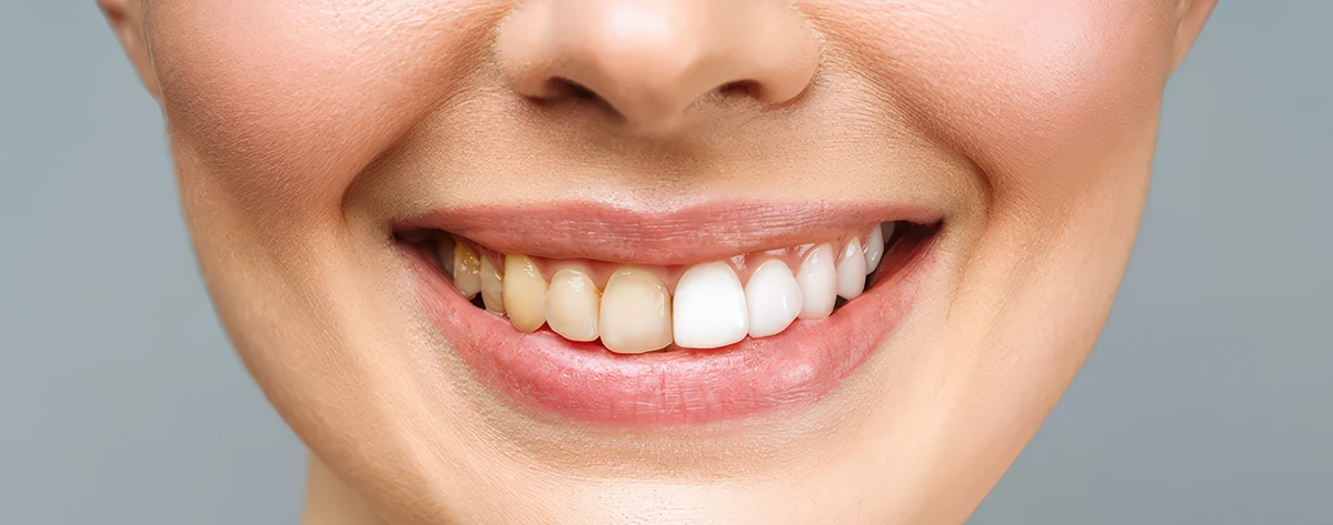 تغییر رنگ در لمینت دندان، دلایل و پیشگیری