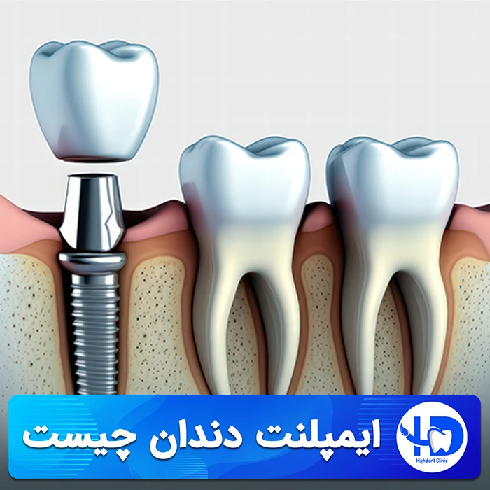 ایمپلنت دندان، معرفی، قیمت ها، انواع