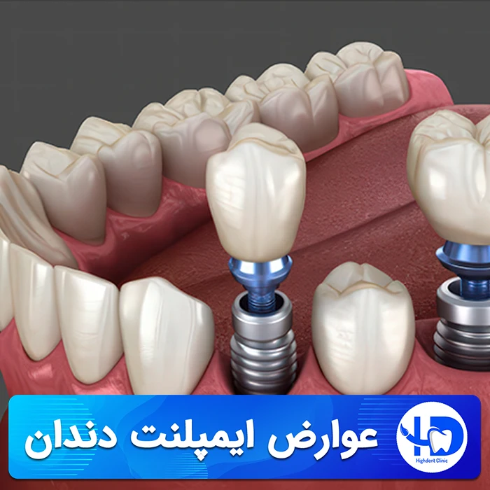 بررسی عوارض ایمپلنت دندان