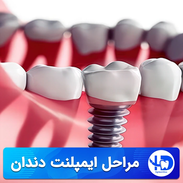 مراحل ایمپلنت دندان، معرفی و بررسی