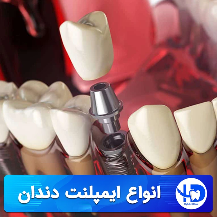 انواع ایمپلنت دندان، معرفی ، روش کاشت، ماندگاری و قیمت ها
