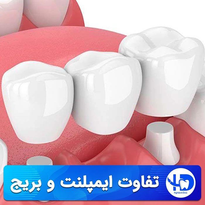 بررسی تفاوت ایمپلنت و بریج دندان