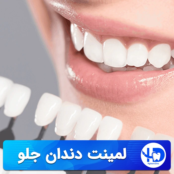 لمینت دندان جلو، مزایا و نکات مهم