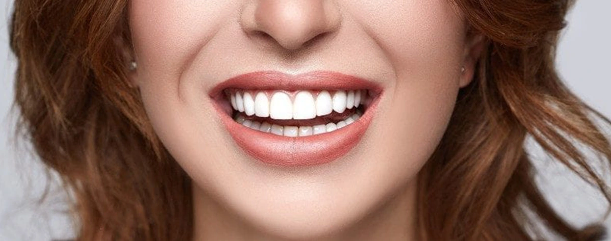 معایب لمینت دندان شکسته