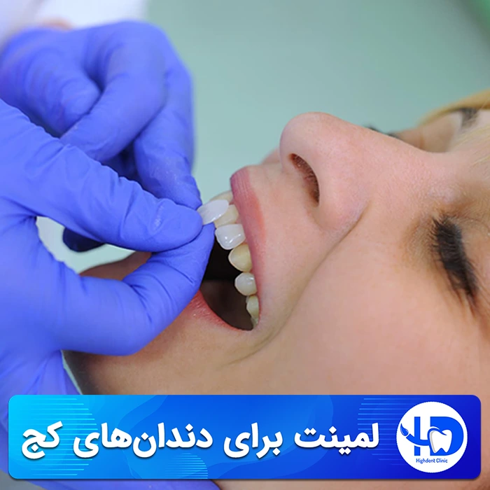 لمینت برای دندان‌ های کج، مرور مزایا و معایب