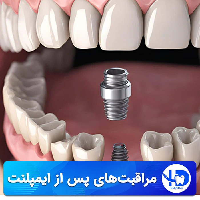 مراقبت ‌های پس از ایمپلنت دندان، ضرورت و نکات مهم