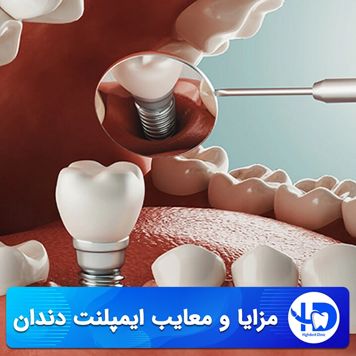 مزایا و معایب ایمپلنت دندان