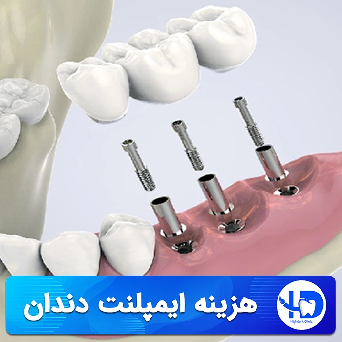 بررسی هزینه ایمپلنت دندان، نوع ایمپلنت و برند انتخابی